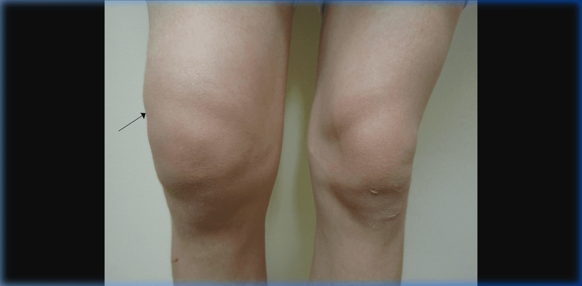 Clinical photograph of a swollen right knee showing joint effusion in the suprapatellar compartment.