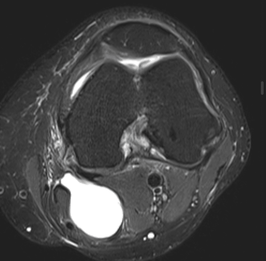Axial MRI of the knee showing a large fluid-filled Baker's cyst in the popliteal fossa, annotated for educational use.