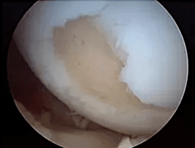 Arthroscopic camera image of the knee joint showing a focal area of cartilage wear on the femoral condyle exposing the subchondral bone.