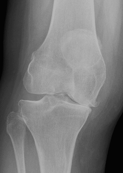 Weight-bearing AP X-ray of an arthritic knee showing narrowing of the medial joint space and increased bone density beneath the worn cartilage zone. Annotation markers highlight key radiological changes.