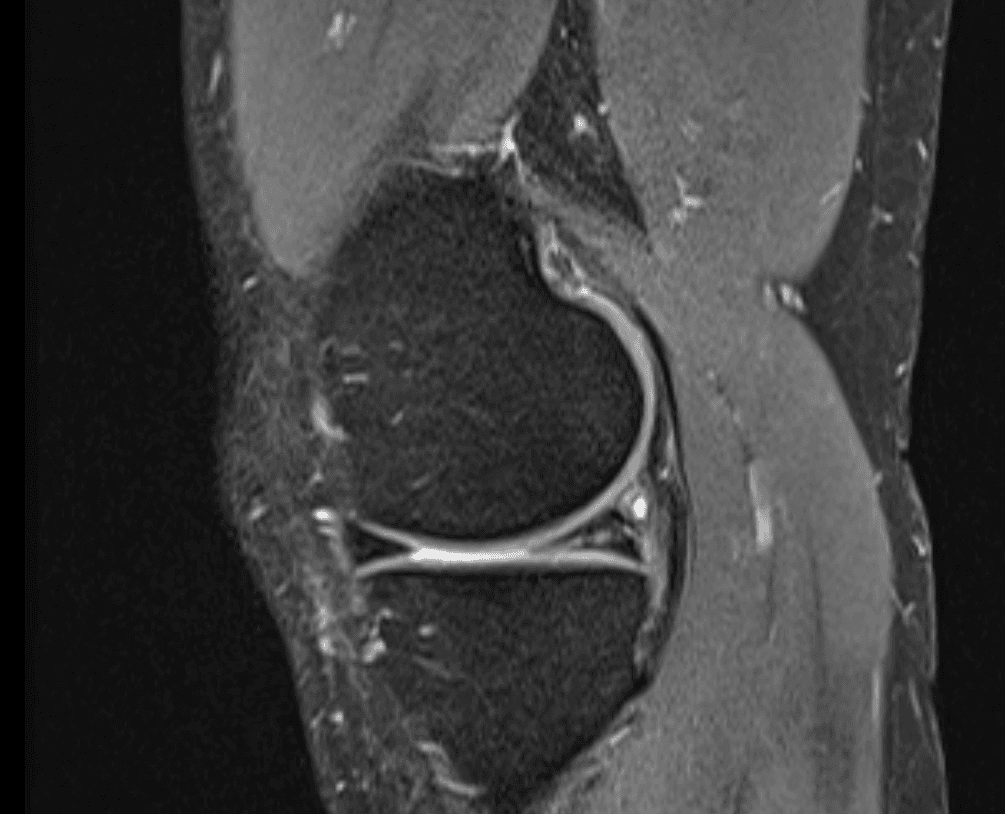 Sagittal MRI of the knee demonstrating signal change within the meniscus consistent with a posterior horn tear. Annotated for educational use.