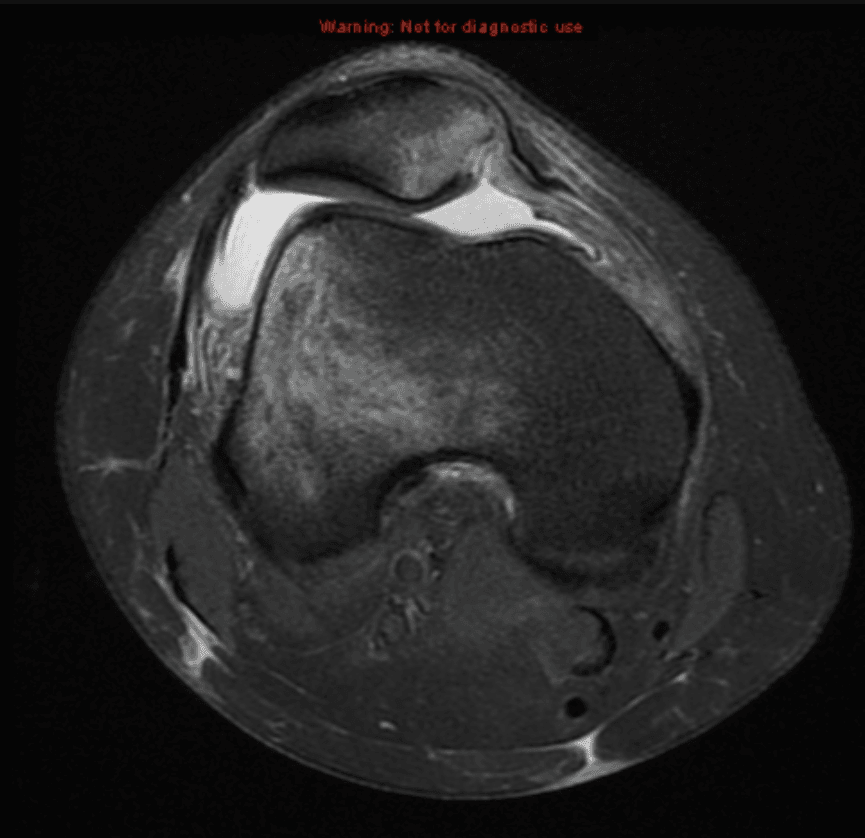 Axial MRI of the patellofemoral joint showing patellar tracking and trochlear groove anatomy, annotated for educational use.