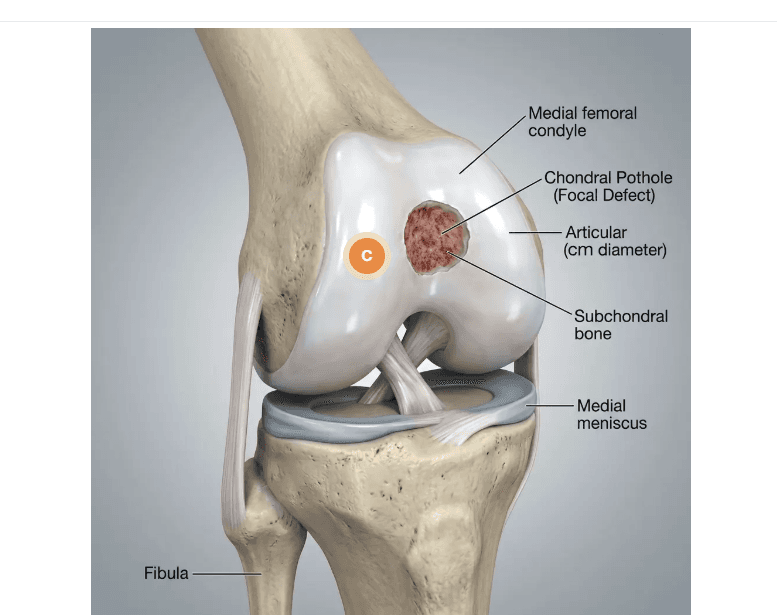 Diagram showing a localized defect in the cartilage lining the femoral condyle, exposing the bone underneath.