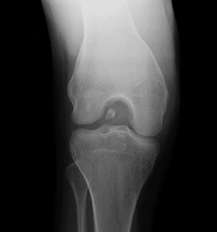 AP X-ray of the knee showing a small round radio-opaque loose body within the intercondylar notch, annotated for educational use.